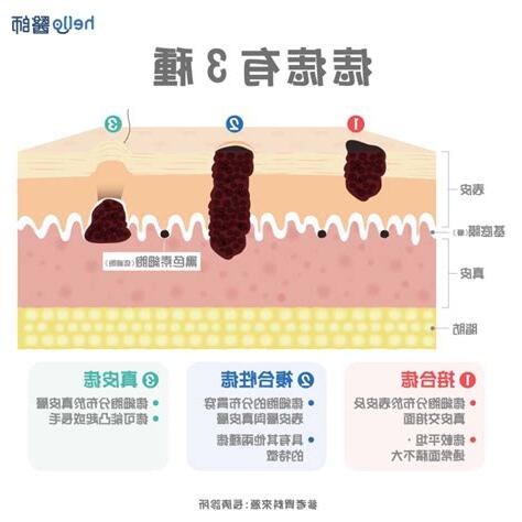長痣 原因